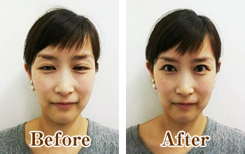 小顔矯正・顎関節矯正 | 文京区茗荷谷・本郷三丁目すぐ！あおやま整骨院